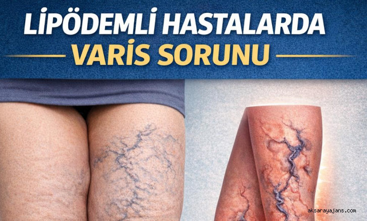 LİPÖDEMLİ HASTALARDA VARİS SORUNU