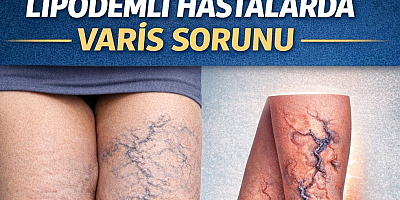 LİPÖDEMLİ HASTALARDA VARİS SORUNU